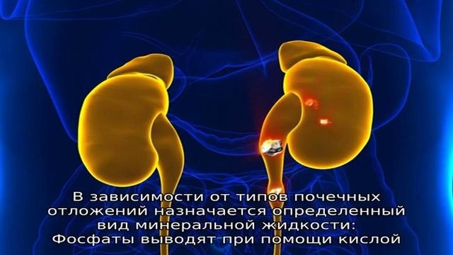 Оксалатные камни в почках