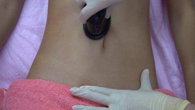 массаж вакуумными банками Si-Line