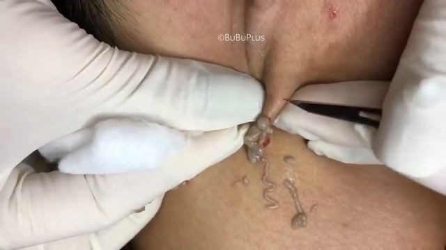 Давим прыщи и черные точки.