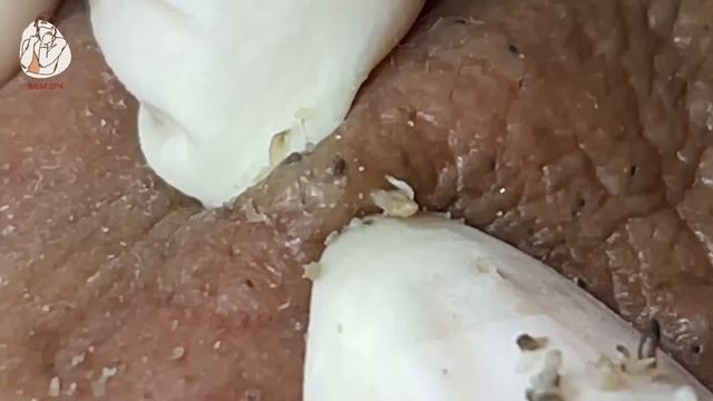 Treatment Of Blackheads And Hidden Acne #032
