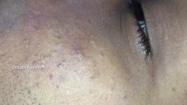 BIG BLACKHEAD REMOVAL Part- 1