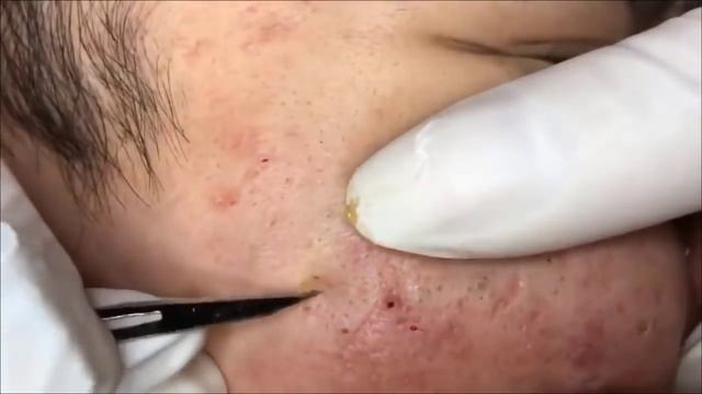 ОГРОМНЫЕ СОЧНЫЕ ЧЕРНЫЕ ТОЧКИ НА ЛИЦЕ, УДАЛЕНИЕ