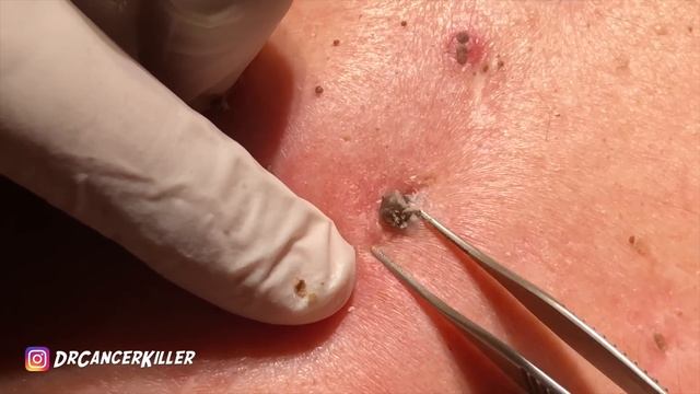 Blackhead REVENGE Part 1 of 3 (part 2  will be published 6/15/19 subscribe to see it)