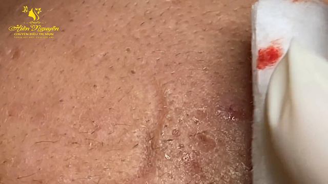 Satisfying video with Hien Nguyen Spa Beauty #016