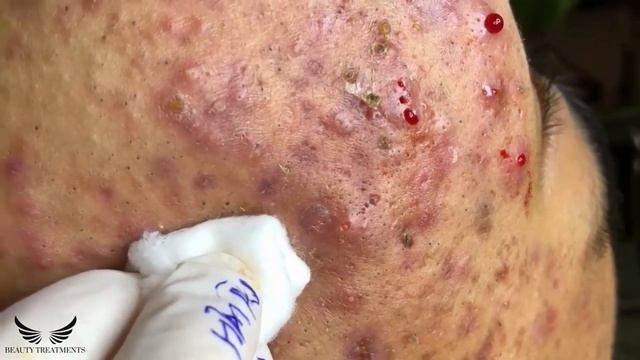 Blackhead Whitehead Removal - Cystic Acne Treatment - Elderly Pimple Popping - Facial Acne Spa |#08