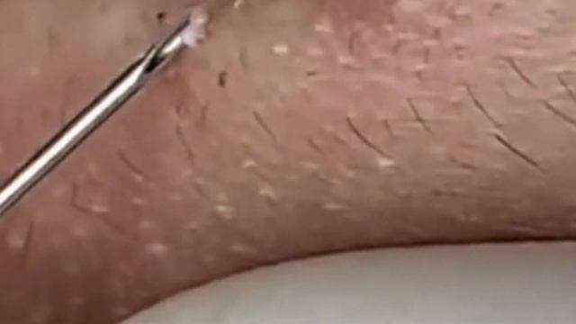 BEAUTY OF SQUEEZE? BLACKHEADS REMOVAL FROM THE LIPS #2  #relaxing  #blackheads