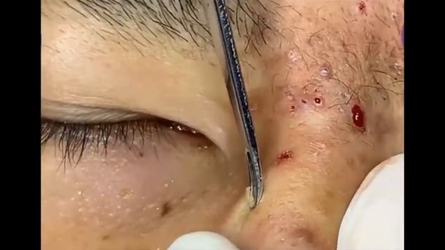 Blackheads on Nose and Forehead - Best Pimple Popping Videos