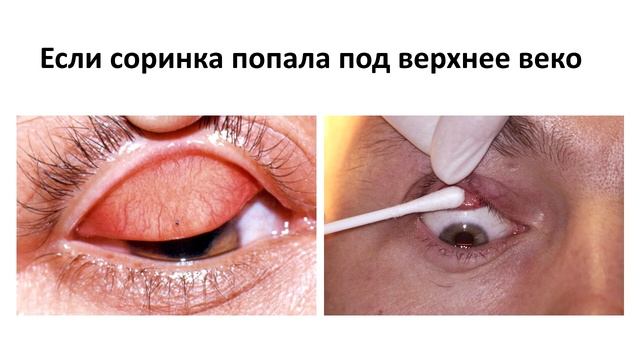 Как удалить соринку из глаза?