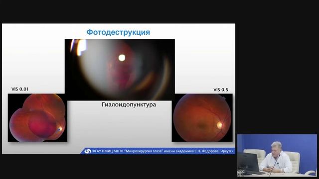 Лазеры в офтальмологии.mp4