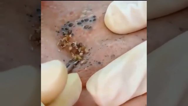 ЗАЛИПАЛОЧКА.ЧИСТКА ОТ ОГРОМНЫХ ЧЁРНЫХ ТОЧЕК|STICKING. CLEANING FROM HUGE BLACK DOTS