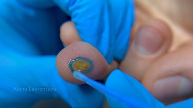 Бородавка в Макро. Как отличить бородавку от мозоли?