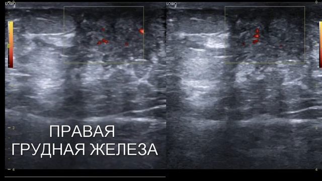как выглядит гинекомастия